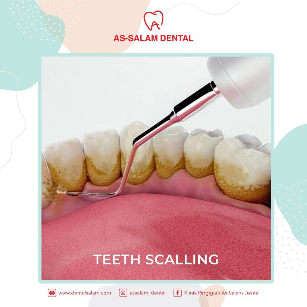 DO YOU KNOW WHAT 'SCALING? AsSalam Dental