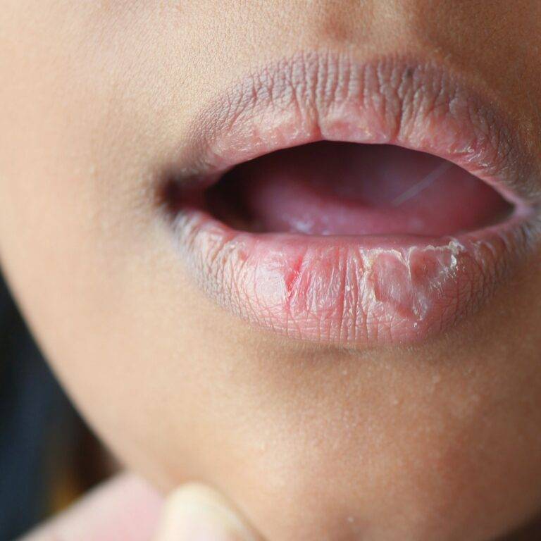 CARA ELAK MULUT KERING KETIKA RAMADAN