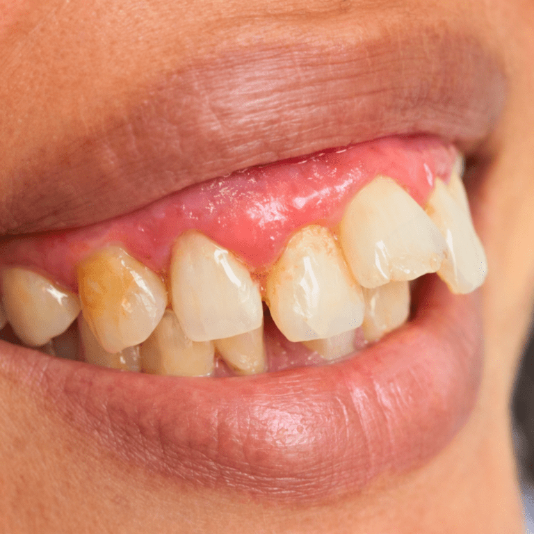 GIGI JONGANG NI PUNCA APA?