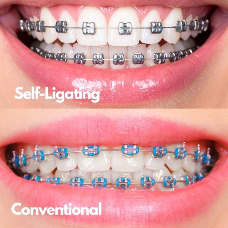 CONVENTIONAL KE SELF-LIGATING BRACES?