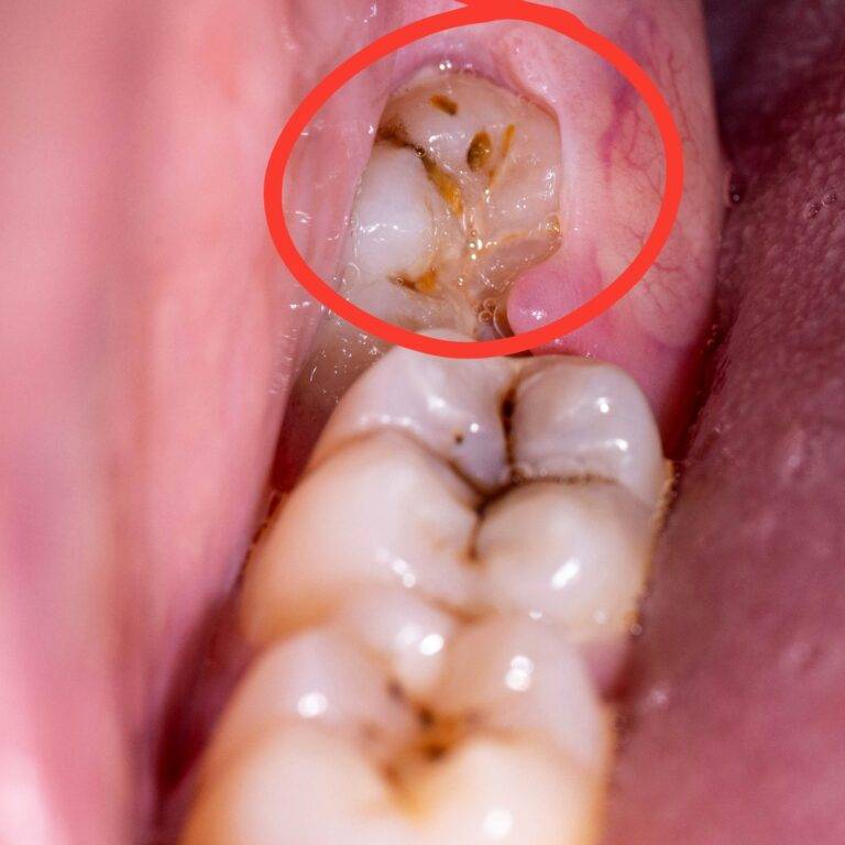 WISDOM TOOTH: KENA CABUT KE?