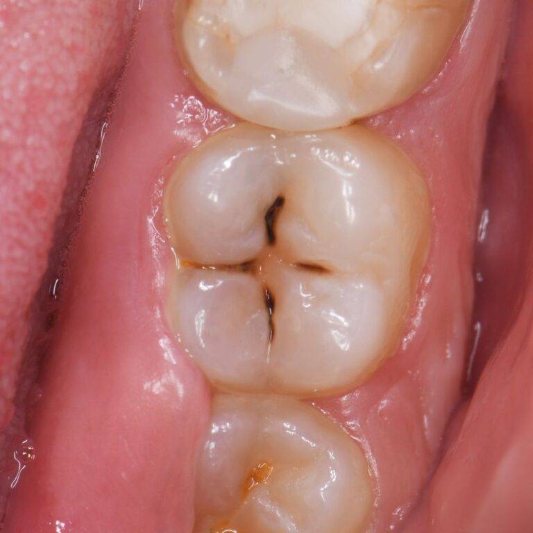 CAVITIES (GIGI BERLUBANG): MASALAH KECIL YANG BOLEH JADI BESAR KALAU DIABAIKAN!
