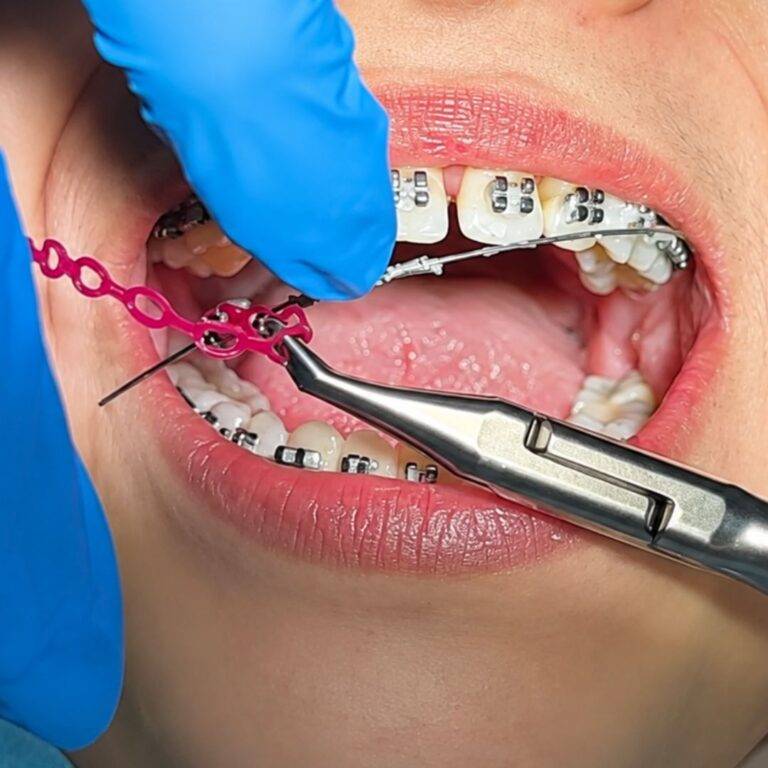 DEBOND BRACES: DAH BOLEH BUKA BRACES? JANGAN EXCITED DULU, ADA STEP PENTING KENA IKUT!
